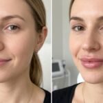 Lip filler before and after results showing natural-looking lip enhancement
