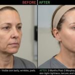 Morpheus8 before and after skin rejuvenation results
